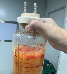 昆山水动力吸脂手术要做多久？